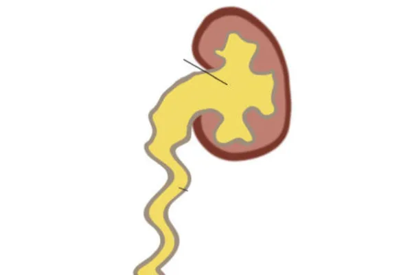 Medical illustration of a kidney and ureter showing the collecting system of the urinary tract