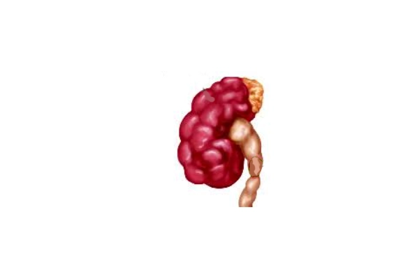 Diagram comparing a normal kidney with a swollen kidney and a distended renal pelvis