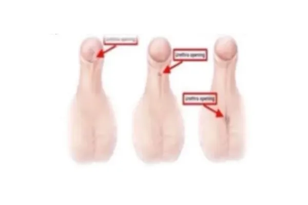 Medical illustration comparing three positions of the urinary opening in hypospadias
