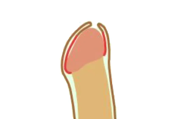 Medical illustration of a tight foreskin that will not pull back over the tip