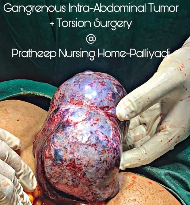Operative photograph from abdominal tumour surgery