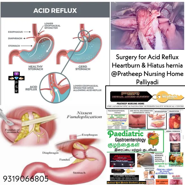 Clinical images relating to acid reflux treatment