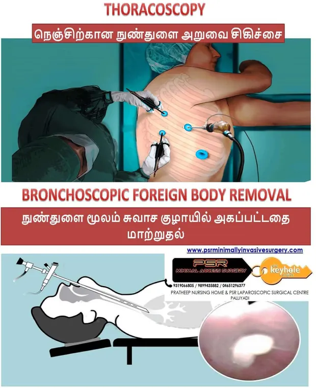 Medical illustration of thoracoscopic chest surgery and bronchoscopic foreign body removal