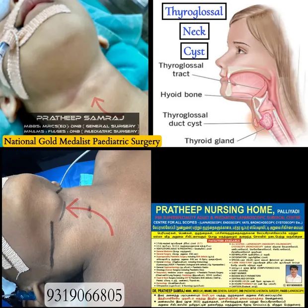 Clinical photographs of a thyroglossal neck cyst with an explanatory anatomical diagram
