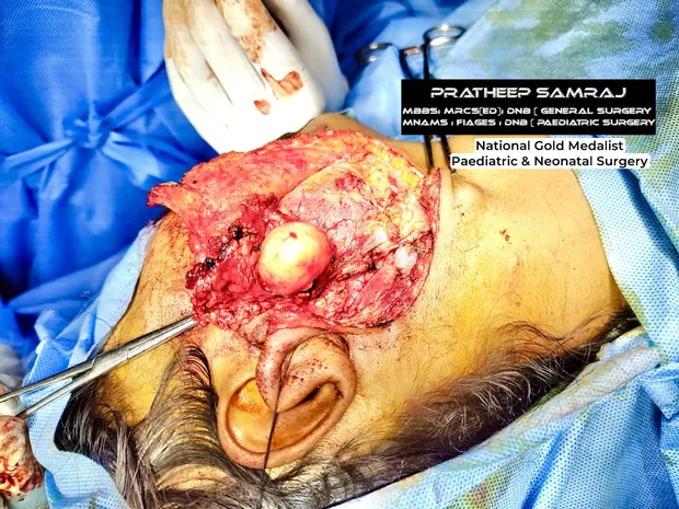 Intra-operative photograph of a head and neck tumour excision