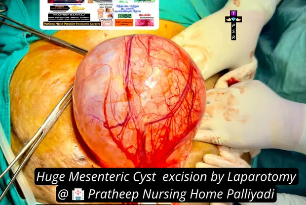 Operative photograph from a large cyst removal procedure