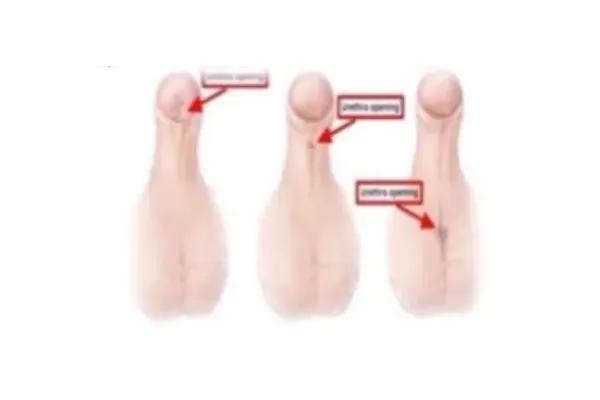 Medical illustration comparing three positions of the urinary opening in hypospadias