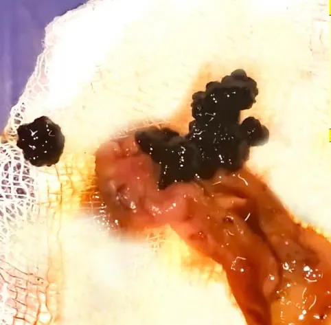 Close-up of a urinary stone removed during a urological procedure