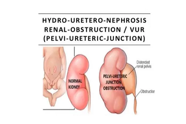 Diagram comparing a normal kidney with a kidney swollen by pelvi-ureteric junction obstruction