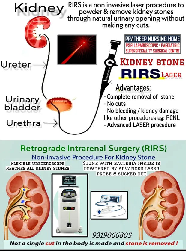 Material from a laser kidney stone removal procedure