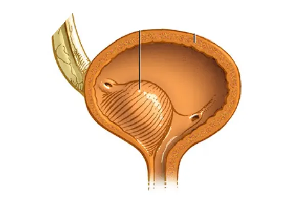 Medical illustration of a ureterocele, a balloon-like swelling of the ureter inside the bladder