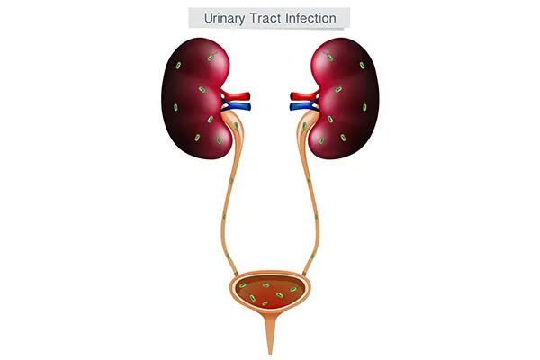 Diagram of the kidneys, ureters and bladder with bacteria spread through the urinary tract