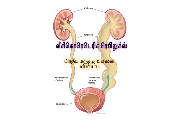 Diagram of vesicoureteral reflux, with urine flowing back from the bladder up the ureter to the kidney