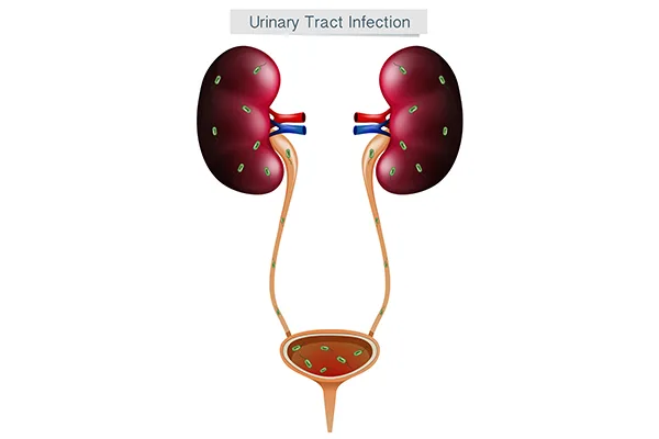 Diagram of the kidneys, ureters and bladder with bacteria spread through the urinary tract